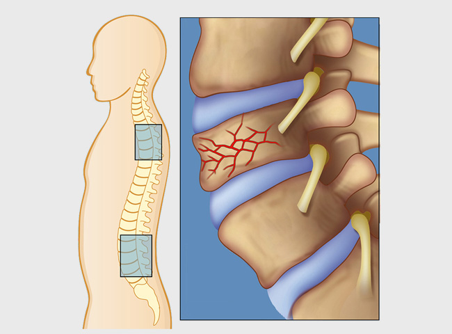 closed fracture of lumbar vertebrae