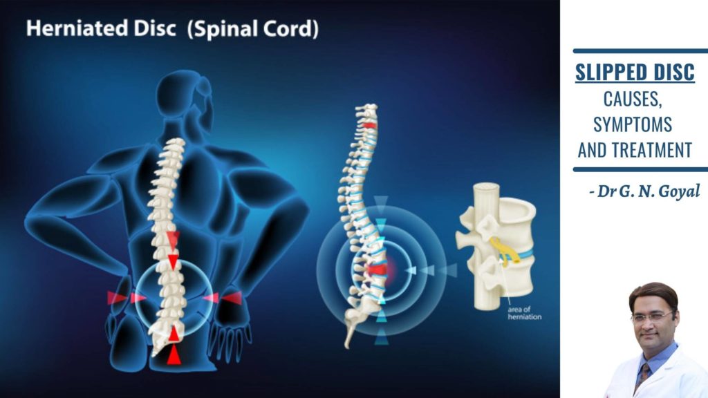 SLIPPED DISC CAUSES, SYMPTOM & TREATMENT Dr. G. N. GOYAL